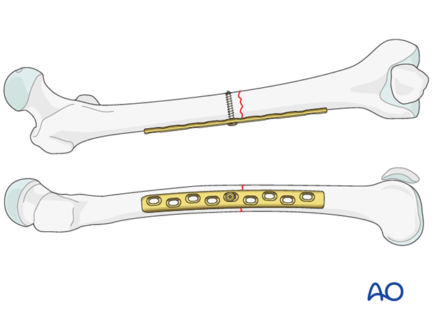 Transverse fracture of femoral shaft – Compression plate – Screw insertion