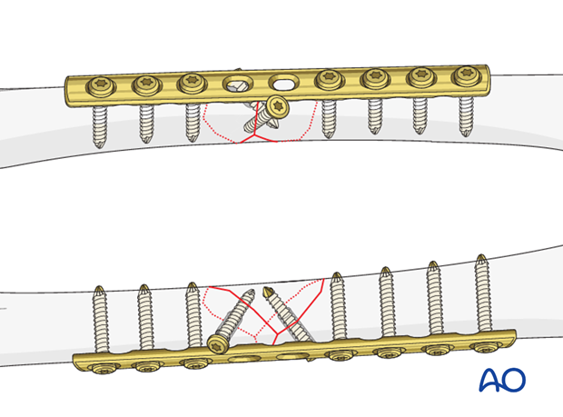 Femoral shaft – Lag screw and protection plate - Principles