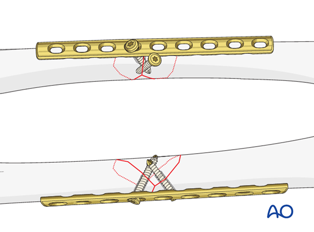 Femoral shaft – Lag screw and protection plate - Fixation of the protection plate