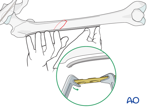 Femoral shaft – Lag screw and protection plate – Reduction and contouring of the plate