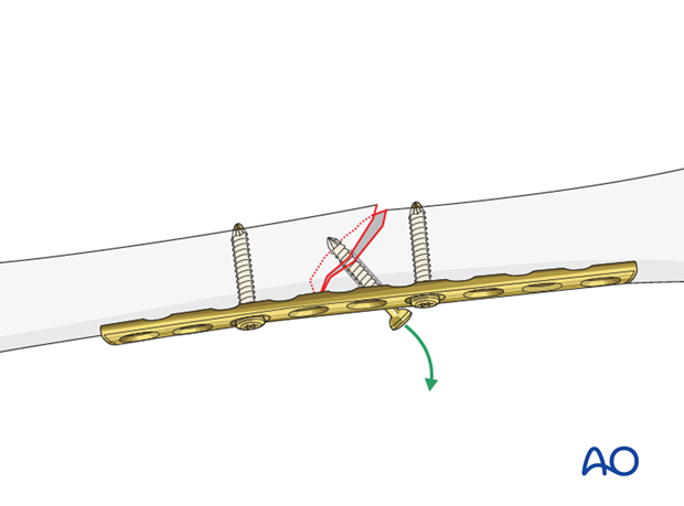 Femoral shaft – Lag screw and protection plate – Principles
