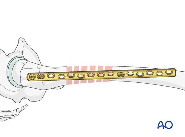 Plate fixation to distal fragment