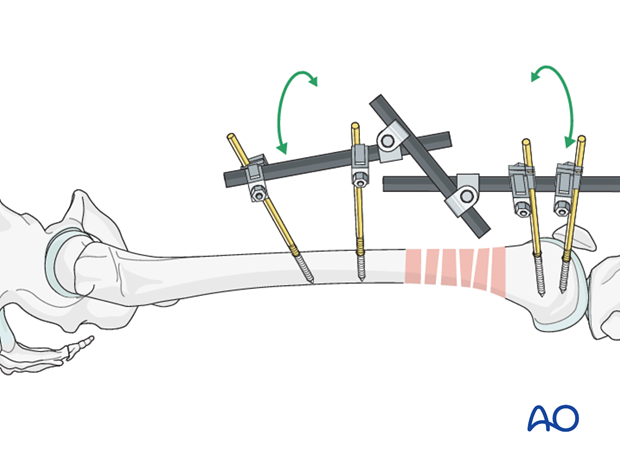 Distal femoral shaft – Minimally invasive bridge plating – Reduction