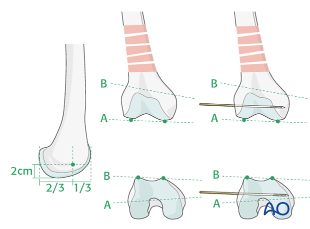 Distal femoral shaft – Minimally invasive bridge plating – Guide wire insertion