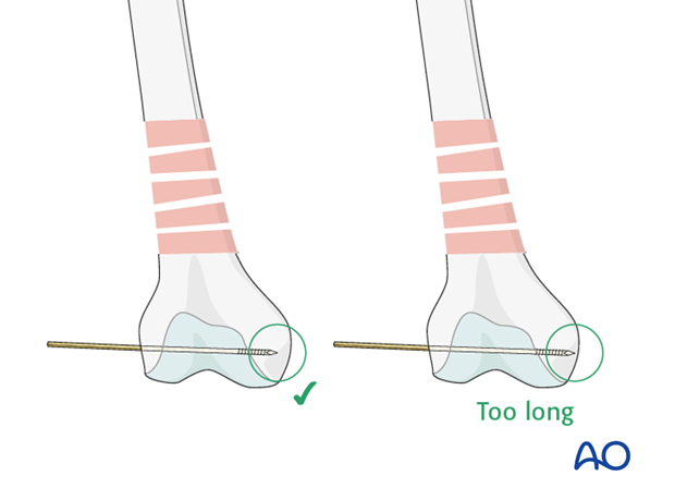 Distal femoral shaft – Minimally invasive bridge plating – Correct guide wire position