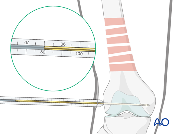 Distal femoral shaft – Minimally invasive bridge plating – Screw lenght