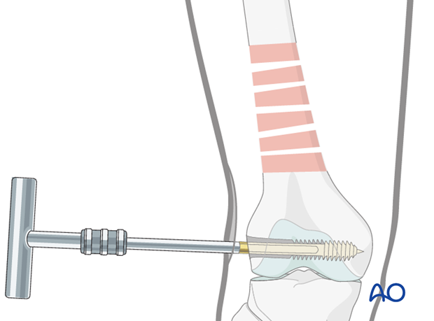 Distal femoral shaft – Minimally invasive bridge plating – Screw insertion