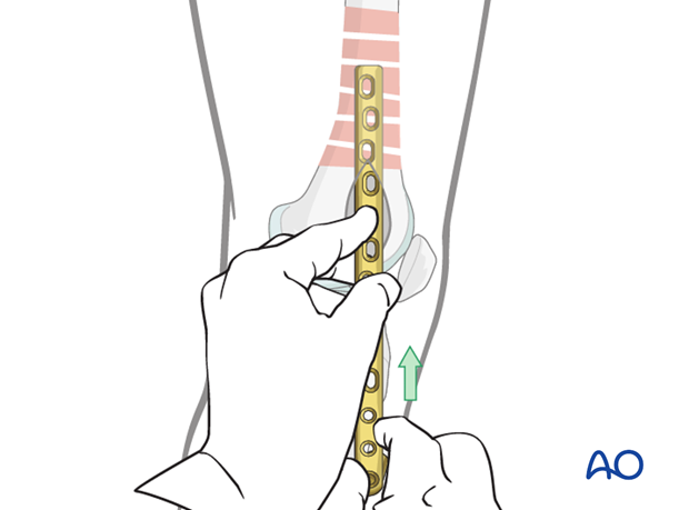 Distal femoral shaft – Minimally invasive bridge plating – Plate placement