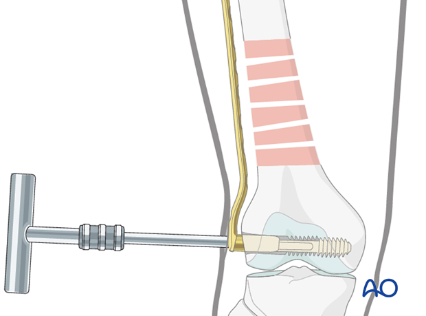 Distal femoral shaft – Minimally invasive bridge plating – Plate fixation to the distal fragment