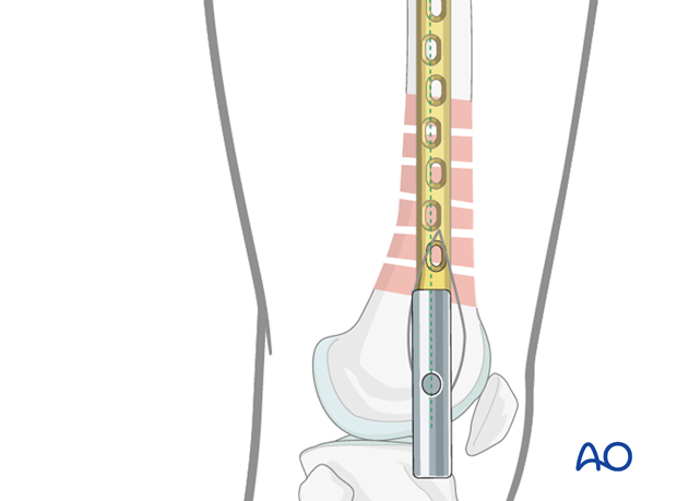 Distal femoral shaft – Minimally invasive bridge plating – Final screw placement