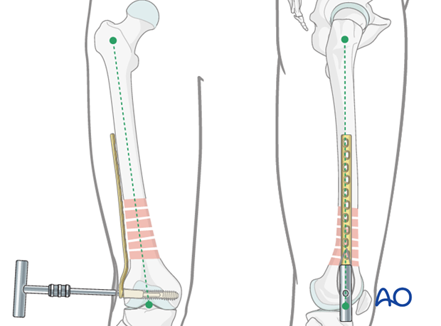 Distal femoral shaft – Minimally invasive bridge plating – Verification of reduction