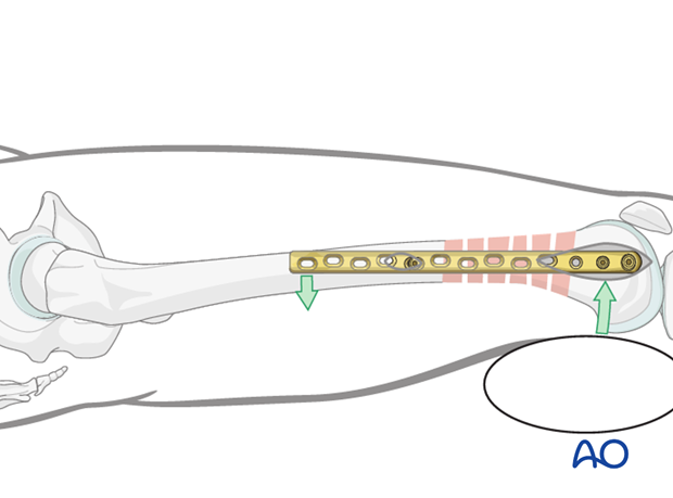 Distal femoral shaft – Minimally invasive bridge plating – Final reduction