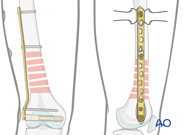 Distal femoral shaft – Minimally invasive bridge plating – Proximal screw