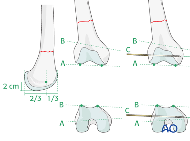 Plate fixation to the distal fragment