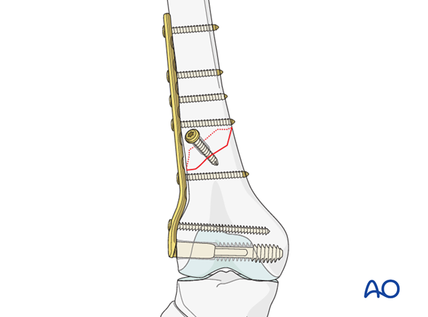 Plate fixation to proximal fragment