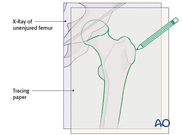 Preoperative planning