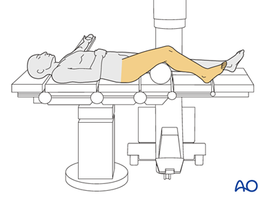 Supine knee flexed 30°