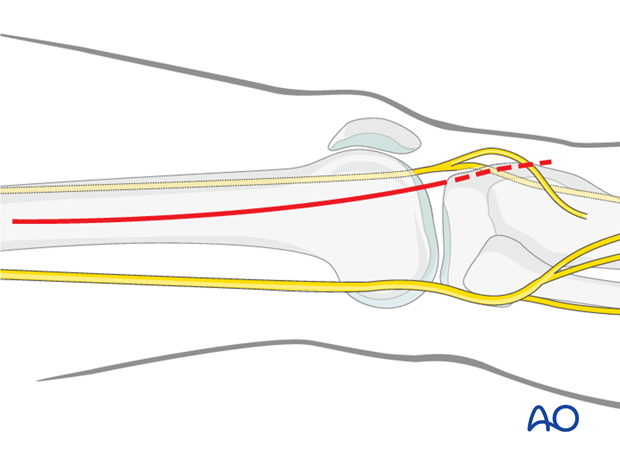 Outline of skin incision