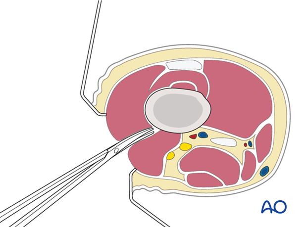 Deep dissection