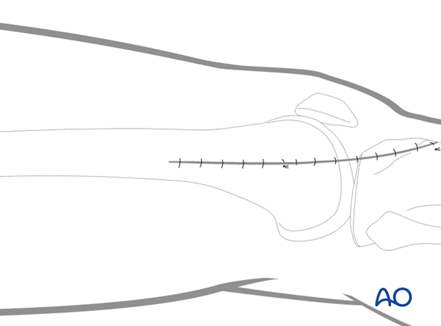 MIPO approach to the distal femur from lateral anterolateral