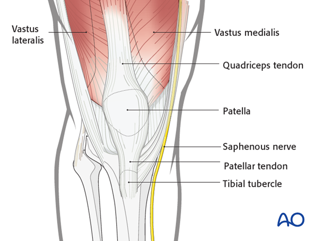 Medial parapatellar approach to the distal femur