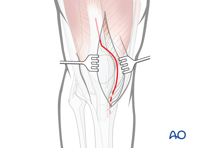 Medial parapatellar approach to the distal femur