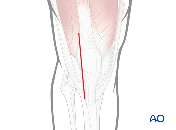 Lateral parapatellar approach