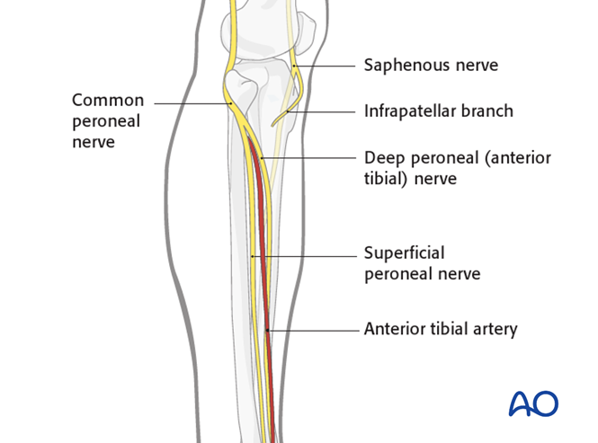 Safe zones in the femur for pin insertion