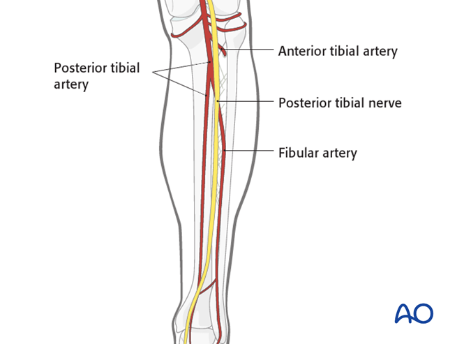 Safe zones in the femur for pin insertion