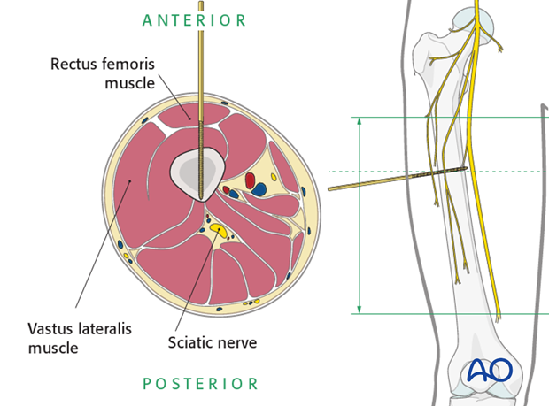 Safe zone in the midshaft of the femur – Anterior pin insertion