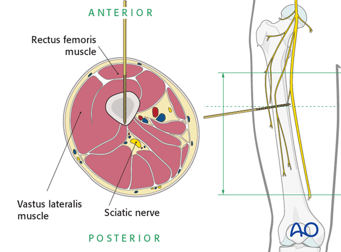 Safe zones in the femur for pin insertion