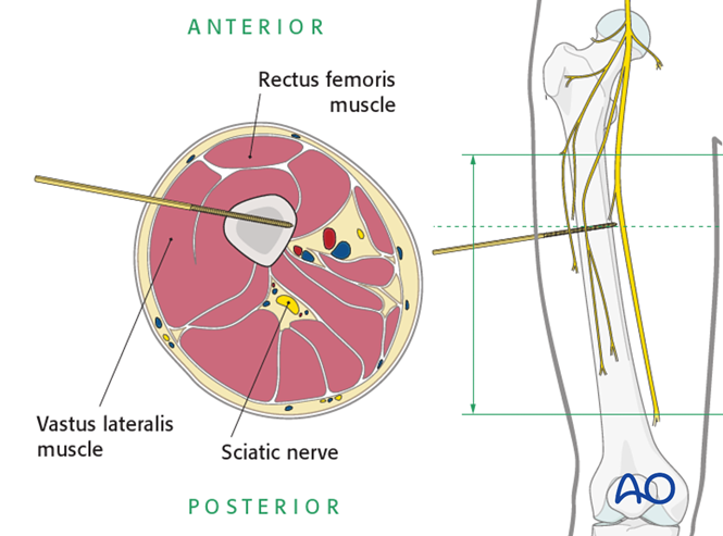 Safe zones in the femur for pin insertion