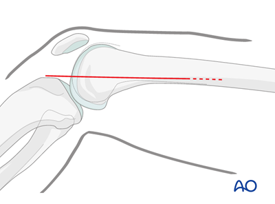 Medial approach to the distal femur