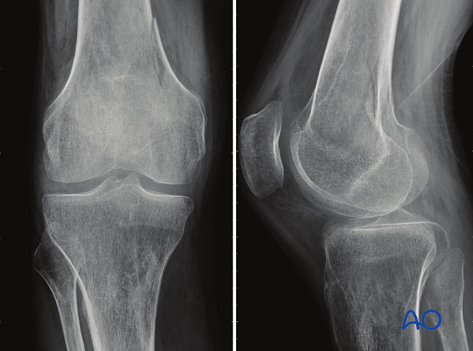 Extraarticular fracture, simple