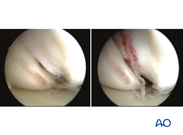 33B1.2 Simple, through the condylar load-bearing surface – arthroscopic view