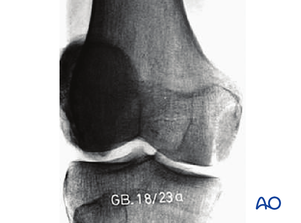 33B2.2 Simple, through the condylar load-bearing surface – X-ray