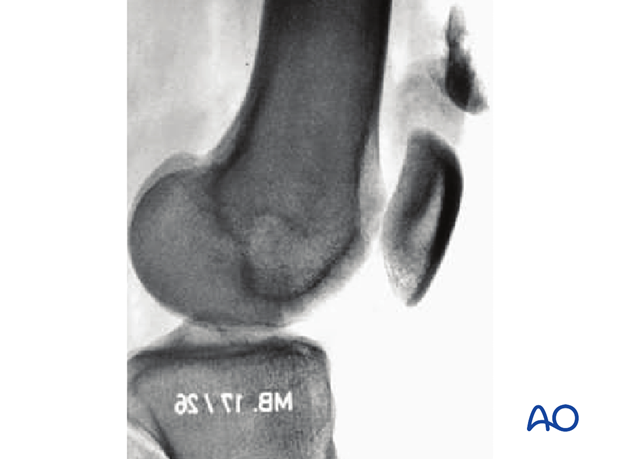 33B3.1 Anterior and lateral flake fracture – X-ray