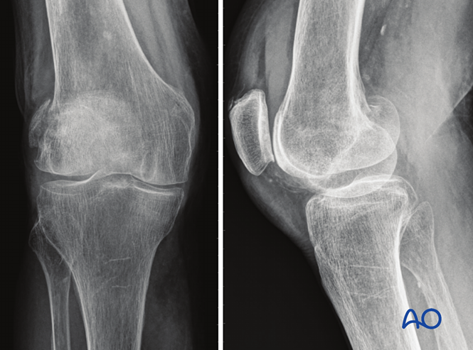 Partial articular fracture, frontal/coronal, posterior condyle(s)