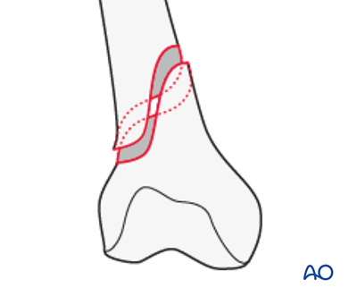 Extraarticular fracture, simple