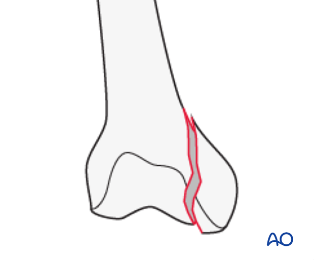 33B2.2 Simple, through the condylar load-bearing surface