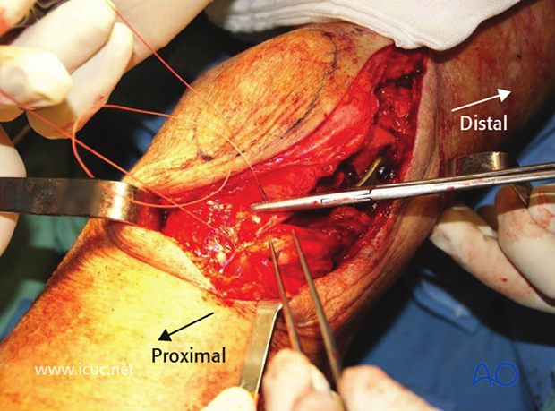 This image shows closure of the lateral parapatellar approach with a heavy suture approximating the tensor fascia lata and the lateral retinaculum.