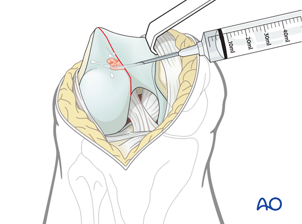 Joint debridement