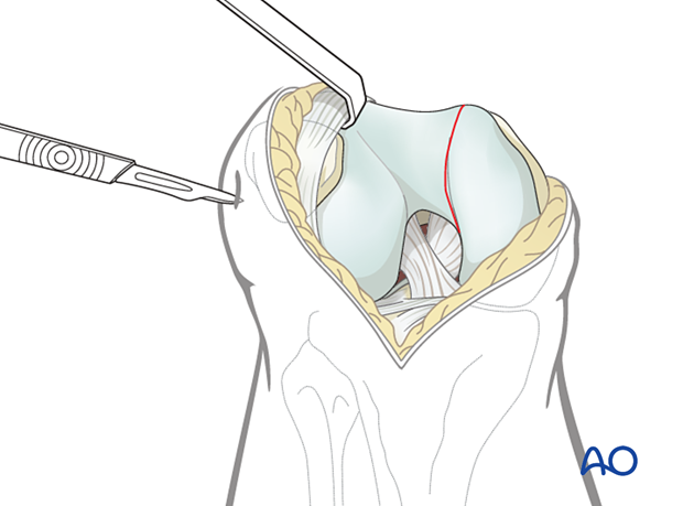 stab incision for the placement of the pointed reduction forceps