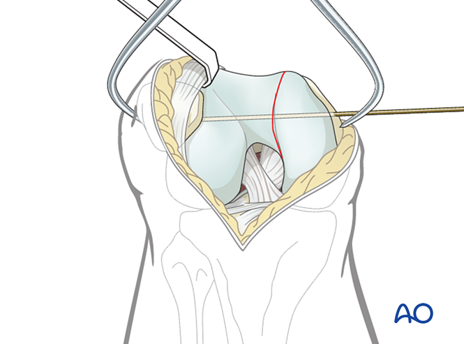 Oref Leg ORIF - Lag screws with or without buttress plate for Partial articular ...