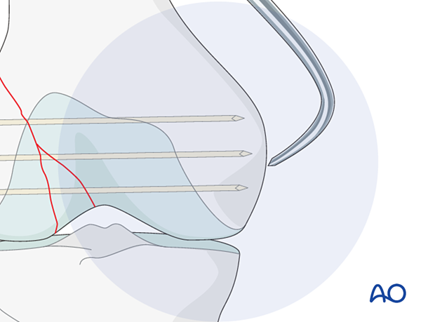 K-wire insertion for cannulated screws