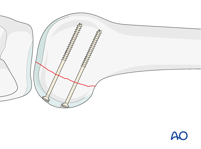 ORIF - Lag screw from posterior with or without plate for Partial ...