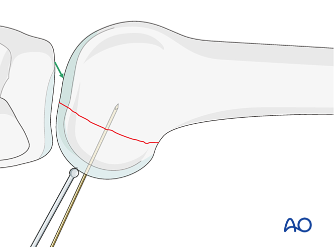 ORIF - Lag screw from posterior with or without plate for Partial ...