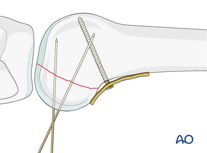 ORIF - Lag screw from posterior with or without plate for Partial ...