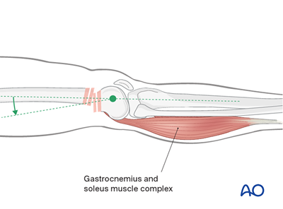 Oref Leg ORIF - Lag screw (epiphysis); ORIF - Bridge plate (metaphysis) for ...