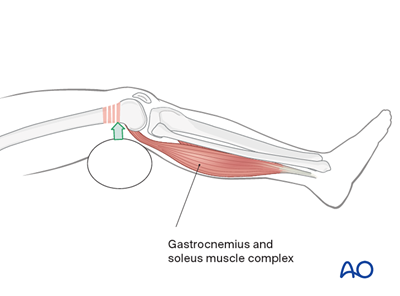 Oref Leg ORIF - Lag screw (epiphysis); ORIF - Bridge plate (metaphysis) for ...